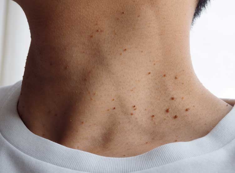 Person with lots of Skin Tags on the neck
