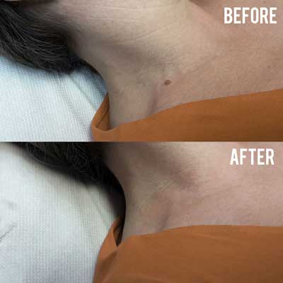 Advanced Cosmetic Procedures Mole removal before and after